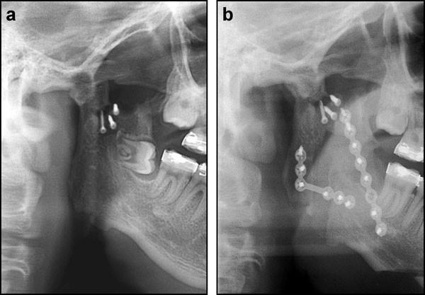Correction of mandibular deficiency by inverted-L osteotomy of ramus and  iliac crest bone grafting | International Journal of Oral Science