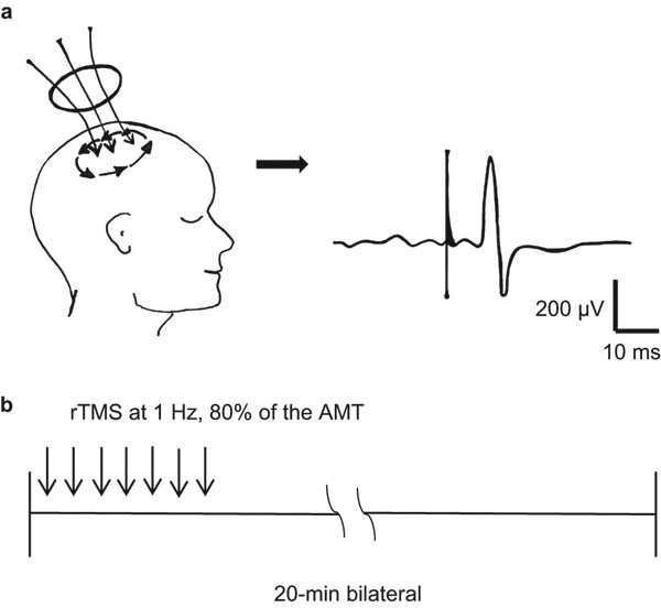 Short Term Effects Of Repetitive Transcranial Magnetic Stimulation On Sleep Bruxism A Pilot Study International Journal Of Oral Science