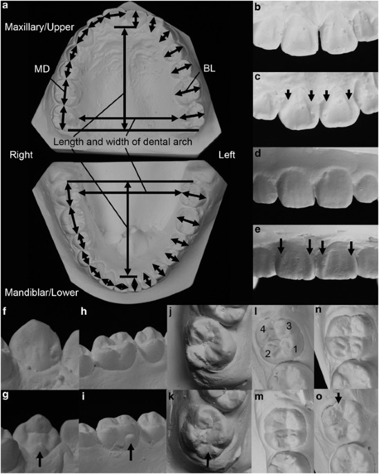 Effects of an Asian-specific nonsynonymous EDAR variant on multiple dental  traits | Journal of Human Genetics