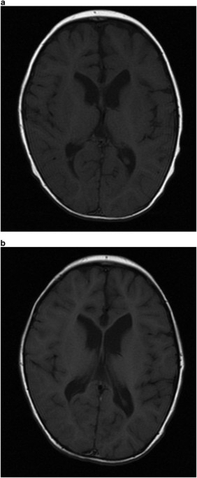 Kif1a mutation in a patient with progressive neurodegeneration