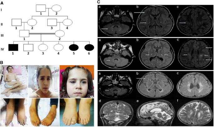 hereditary spastic paraplegia 4