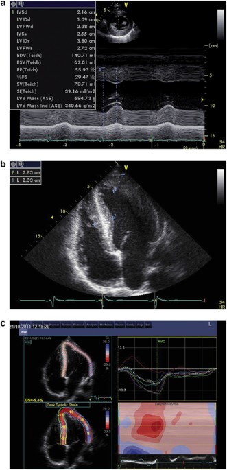 22 Year Old Patient With Malignant Hypertension Associated With Primary Aldosteronism Journal Of Human Hypertension 22 Year Old Patient With Malignant Hypertension Associated With Primary Aldosteronism Journal Of Human Hypertension