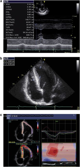 22 Year Old Patient With Malignant Hypertension Associated With Primary Aldosteronism Journal Of Human Hypertension