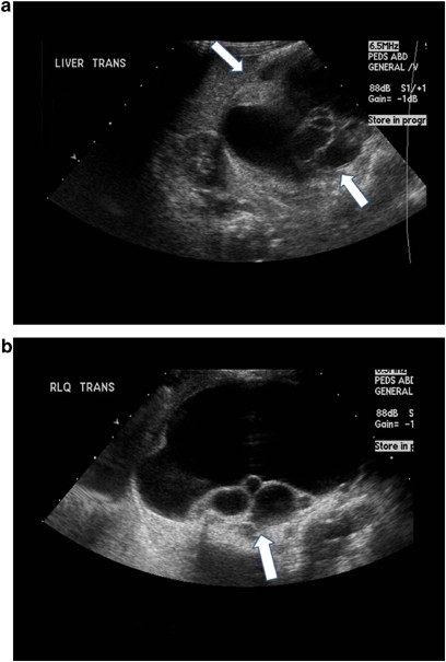 Congenital gastric teratoma | Journal of Perinatology