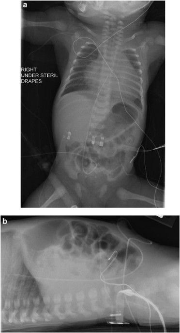Congenital absence of ductus venosus: an umbilical catheter with an abnormal path