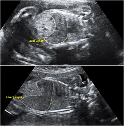 Fetal Liver Length Measurement At Mid Pregnancy Among Fetuses At Risk As A Predictor Of Hemoglobin Bart S Disease Journal Of Perinatology Fetal Liver Length Measurement At Mid Pregnancy Among Fetuses At Risk As A Predictor Of Hemoglobin Bart S Disease Journal Of Perinatology