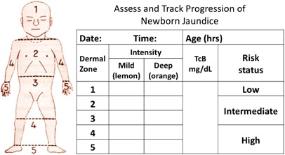 Transcutaneous Bilirubin Level Chart