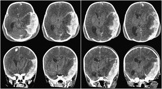 Massive intracranial hemorrhage caused by neonatal alloimmune thrombocytopenia associated with anti-group a antibody