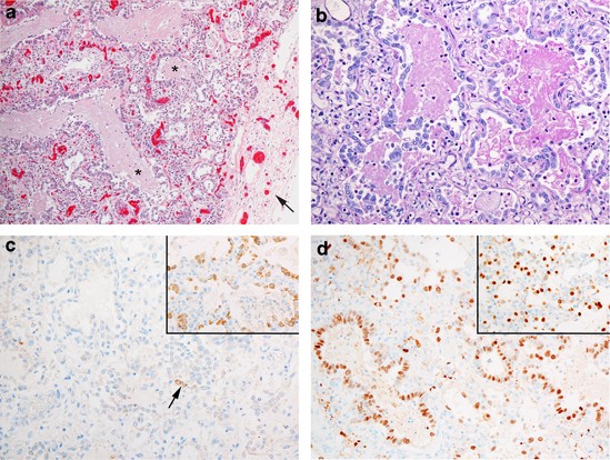 Novel nkx2. 1 mutation associated with hypothyroidism and lethal respiratory failure in a full-term neonate