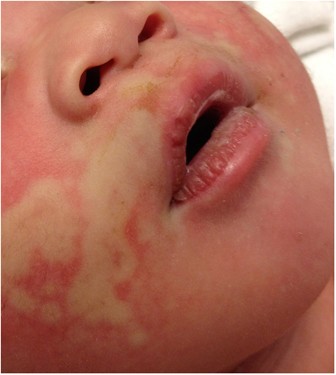 Local facial cutaneous vasoconstriction: an unusual complication of inhaled racemic epinephrine in a neonate | Journal of Perinatology Local facial cutaneous vasoconstriction: an unusual complication of inhaled racemic epinephrine in a neonate | Journal of Perinatology