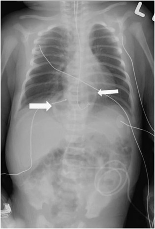Neonatal marfan syndrome with hiatus hernia and intrathoracic stomach | Journal of Perinatology Neonatal marfan syndrome with hiatus hernia and intrathoracic stomach | Journal of Perinatology