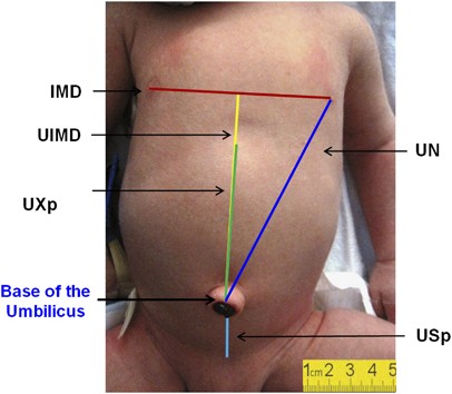 Simple Measurements To Place Umbilical Catheters Using Surface Anatomy Journal Of Perinatology