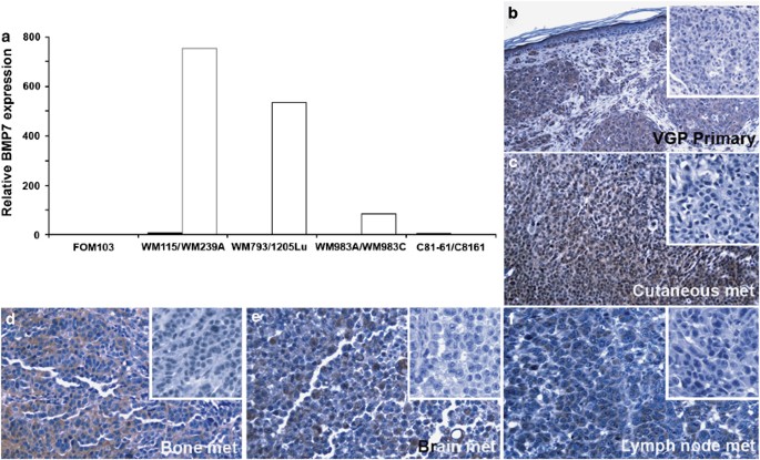 Aggressive melanoma cells escape from bmp7-mediated autocrine growth inhibition through coordinated noggin upregulation