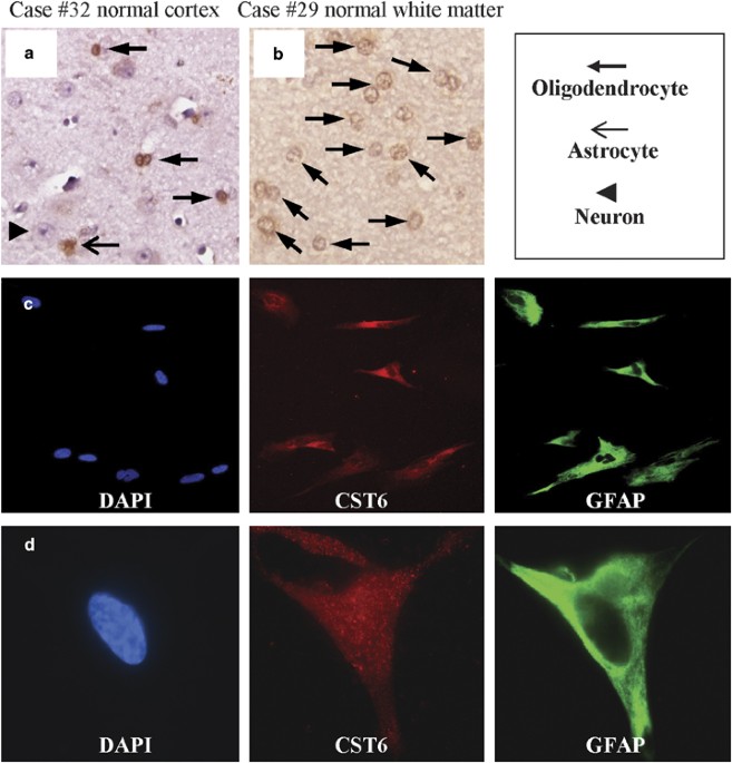 Invasion Suppressor Cystatin E M Cst6 High Level Cell Type Specific Expression In Normal Brain And Epigenetic Silencing In Gliomas Laboratory Investigation