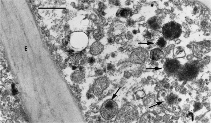 Role of extracellular membrane vesicles in the pathogenesis of various  diseases, including cancer, renal diseases, atherosclerosis, and arthritis  | Laboratory Investigation