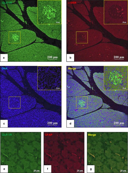glp-1 pancreatitis class action in louisiana PSCs and GLP-1R: occurrence in normal pancreas, acute/chronic pancreatitis  and effect of their activation by a GLP-1R agonist