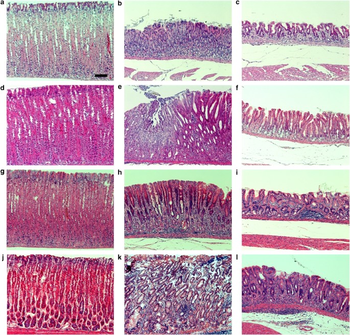 Emergence Of Spasmolytic Polypeptide Expressing Metaplasia In Mongolian Gerbils Infected With Helicobacter Pylori Laboratory Investigation