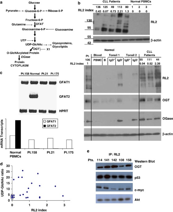 Aberrant o-glcnacylation characterizes chronic lymphocytic leukemia