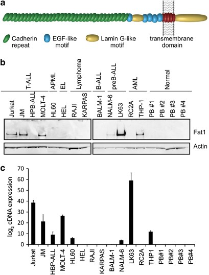 The fat1 cadherin is overexpressed and an independent prognostic factor for survival in paired diagnosis–relapse samples of precursor b-cell acute lymphoblastic leukemia