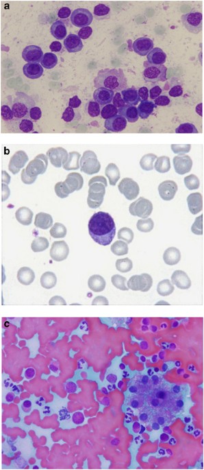 plasma cell leukemia