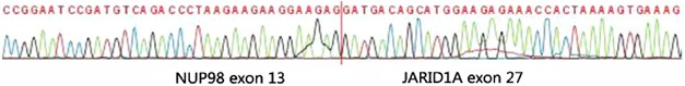 Nup98/jarid1a is a novel recurrent abnormality in pediatric acute megakaryoblastic leukemia with a distinct hox gene expression pattern