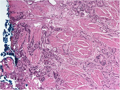 bladder neck involvement prostate cancer Prostatitis férfiakban A gyógynövények szedése