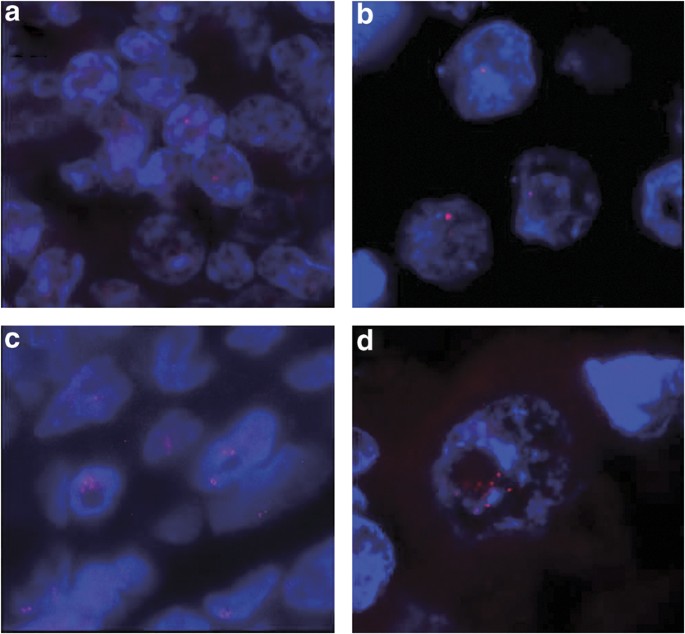 PDF) ACTN4 gene amplification is a predictive biomarker for