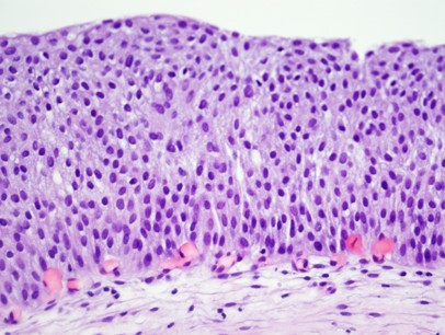 Atypical papillary urothelial hyperplasia