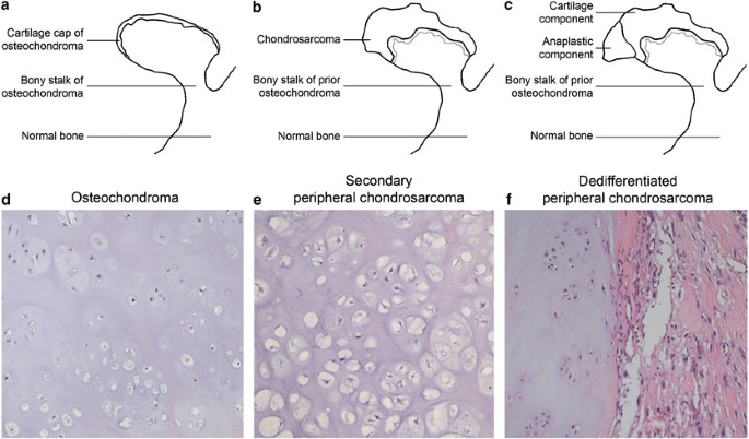 Dedifferentiated peripheral chondrosarcomas: regulation of EXT-downstream  molecules and differentiation-related genes | Modern Pathology