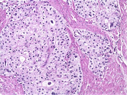 papillary urothelial neoplasia ou de helminth la un copil