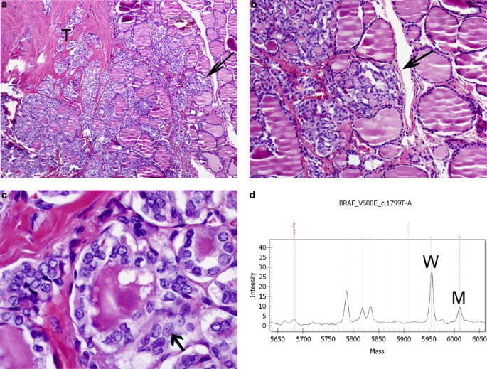 Molecular genotyping of papillary thyroid carcinoma follicular variant  according to its histological subtypes (encapsulated vs infiltrative)  reveals distinct BRAF and RAS mutation patterns | Modern Pathology