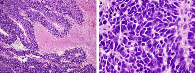 Microscopic view of small cell lung cancer cells, highlighting their appearance. (springernature.com)