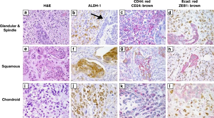 Metaplastic breast carcinomas are enriched in markers of tumor-initiating  cells and epithelial to mesenchymal transition | Modern Pathology