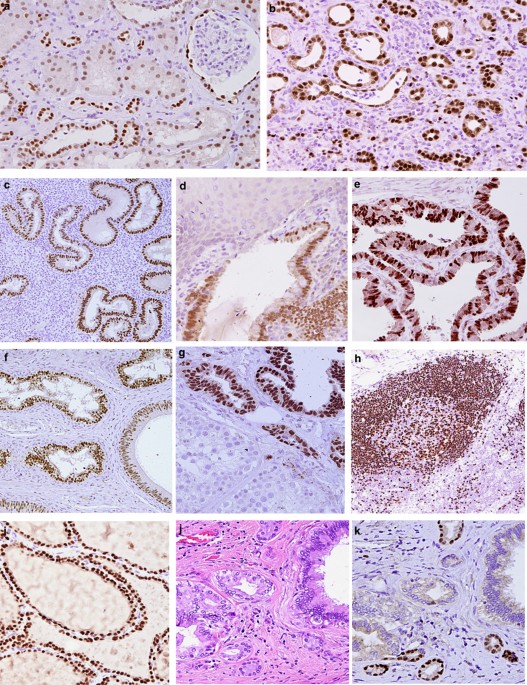 PAX 8 expression in non-neoplastic tissues, primary tumors, and metastatic  tumors: a comprehensive immunohistochemical study | Modern Pathology