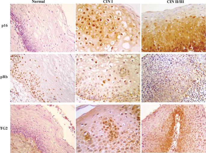 Role and predictive strength of transglutaminase type 2 expression in  premalignant lesions of the cervix | Modern Pathology