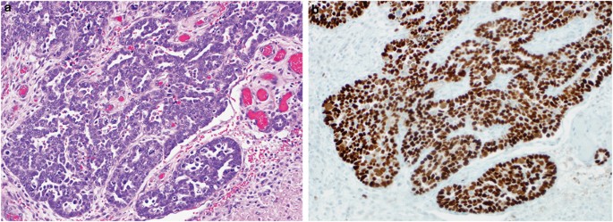 Immunohistochemical Staining Patterns Of P53 Can Serve As A Surrogate Marker For Tp53 Mutations In Ovarian Carcinoma An Immunohistochemical And Nucleotide Sequencing Analysis Modern Pathology