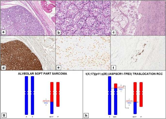 Differential Expression Of Cathepsin K In Neoplasms Harboring Tfe3 Gene Fusions Modern Pathology