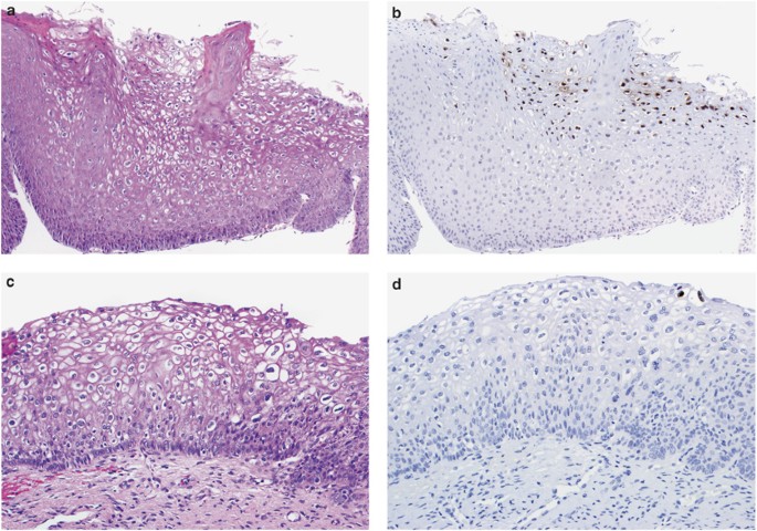 Immunohistochemical detection of human papillomavirus capsid proteins L1  and L2 in squamous intraepithelial lesions: potential utility in diagnosis  and management | Modern Pathology