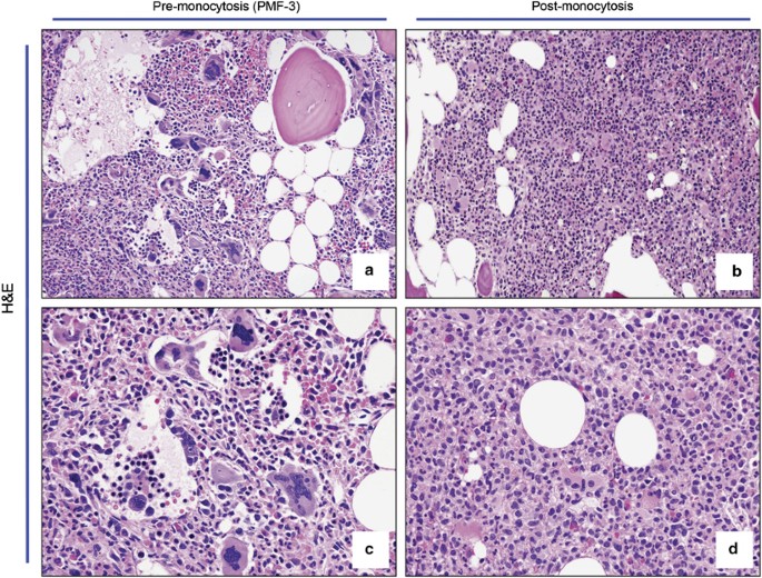 Development Of Monocytosis In Patients With Primary Myelofibrosis Indicates  An Accelerated Phase Of The Disease | Modern Pathology