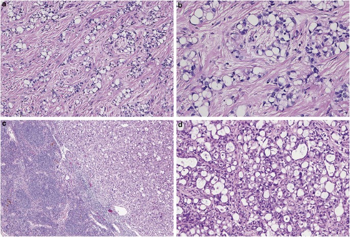 Mesothelioma with signet-ring cell features: report of 23 cases | Modern  Pathology