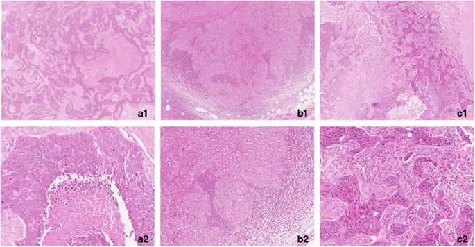 Comparison of basal-like triple-negative breast cancer defined by  morphology, immunohistochemistry and transcriptional profiles | Modern  Pathology