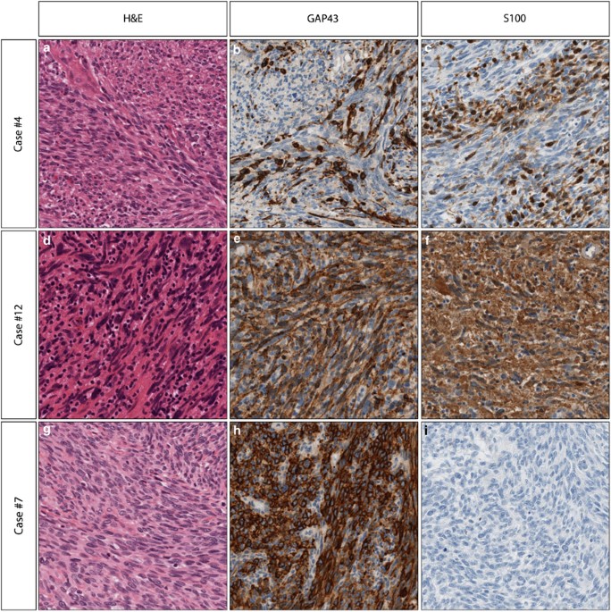 metastatic melanotic peripheral Malignant Melanotic Nerve Sheath Tumor of the Neck: A Case Report
