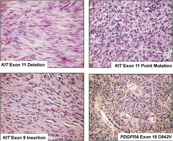 Gastrointestinal Stromal Tumors: What Do We Know Now? | Modern Pathology