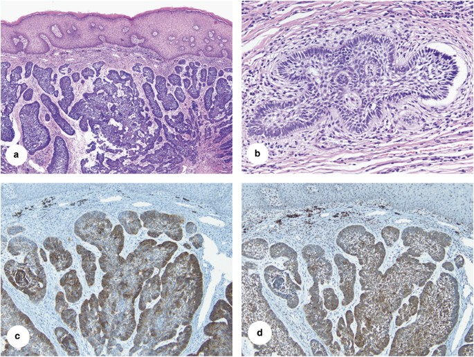 Clinicopathological Analysis Of Basal Cell Carcinoma Of The Anal