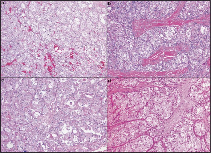 Molecular Cytogenetic Analysis For Tfe3 Rearrangement In Xp11 2 Renal Cell Carcinoma And Alveolar Soft Part Sarcoma Validation And Clinical Experience With 75 Cases Modern Pathology Molecular Cytogenetic Analysis For Tfe3 Rearrangement In Xp11 2 Renal Cell Carcinoma And Alveolar Soft Part Sarcoma Validation And Clinical Experience With 75 Cases Modern Pathology