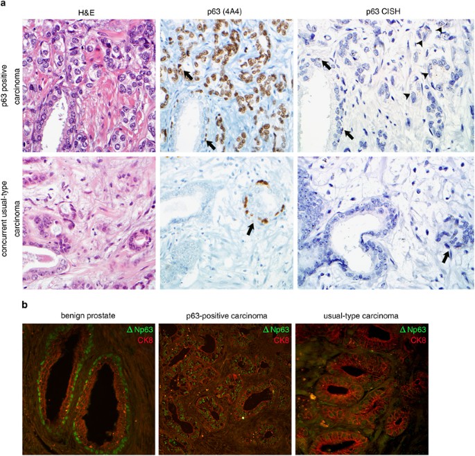 prostate adenocarcinoma cytokeratin