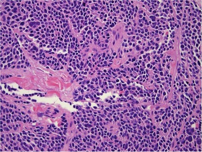 Cytokeratin 20 Negative Merkel Cell Carcinoma Is Infrequently Associated With The Merkel Cell Polyomavirus Modern Pathology
