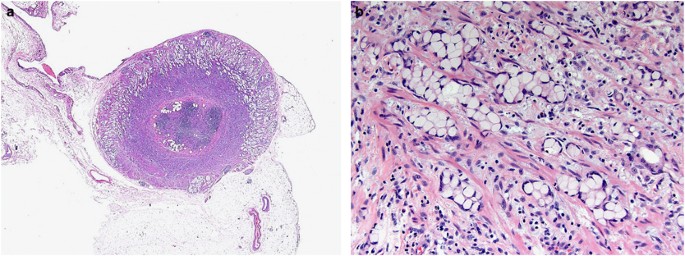 Goblet cell carcinomas of the appendix: rare but aggressive neoplasms with  challenging management in: Endocrine Connections Volume 7 Issue 2 (2018)