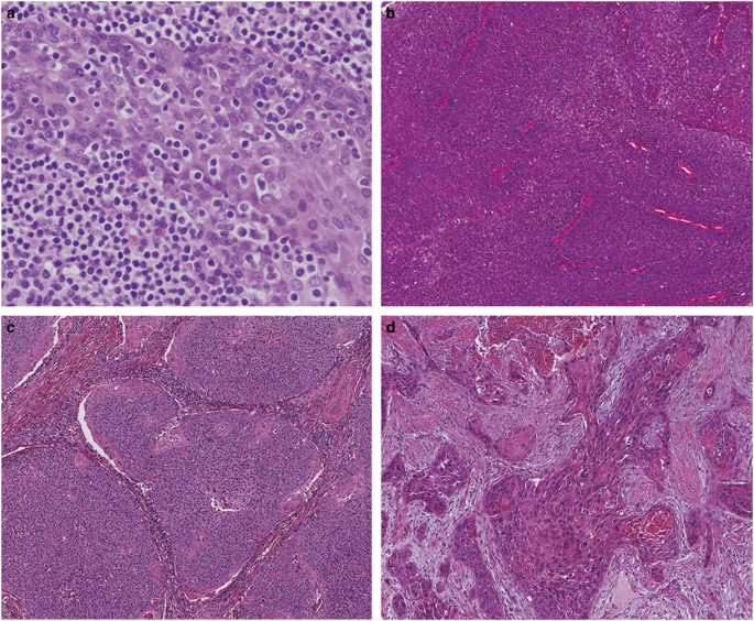 A HPV (humán papillomavírus) fertőzés tünetei, kezelése Papillomavírus mst kezelés