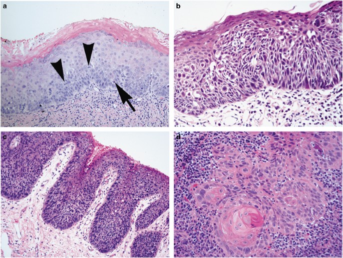 squamous cell carcinoma in situ histology